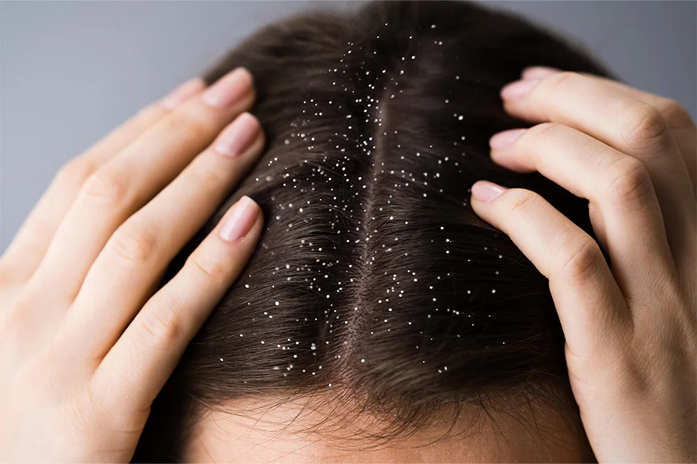 ವಿಪರೀತ ತಲೆಹೊಟ್ಟು (Dandruff) - RJR Herbal Hospitals Treatment ವಿಪರೀತ ತಲೆಹೊಟ್ಟು (Dandruff) - ಗಿಡಮೂಲಿಕೆ ಚಿಕಿತ್ಸೆ