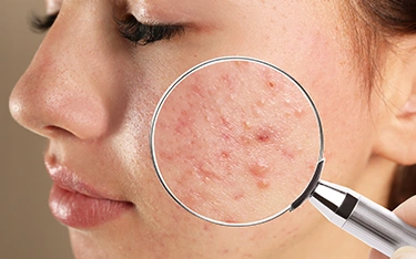 ಮೊಡವೆಗಳು (Pimples) - RJR Herbal Hospitals Treatment ಮೊಡವೆಗಳು (Pimples) - ಗಿಡಮೂಲಿಕೆ ಚಿಕಿತ್ಸೆ